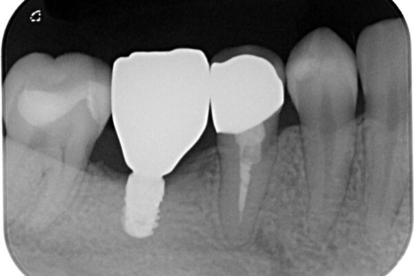銀歯をやり替えたい。インプラントとセラミックによる治療 治療後画像