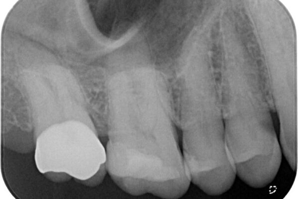 食事中に歯が欠けたので治したい。オールセラミッククラウンによる補綴 治療後画像