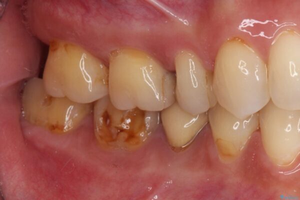 奥歯が欠けてしまった　オールセラミッククラウンによる補綴治療 治療前画像