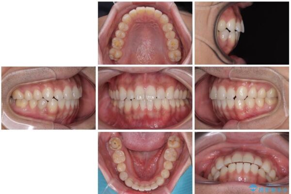 目立たない装置でデコボコを改善　ハーフリンガルによる矯正治療 治療後画像