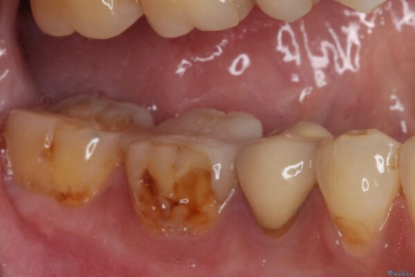 奥歯が欠けてしまった　オールセラミッククラウンによる補綴治療 治療前画像