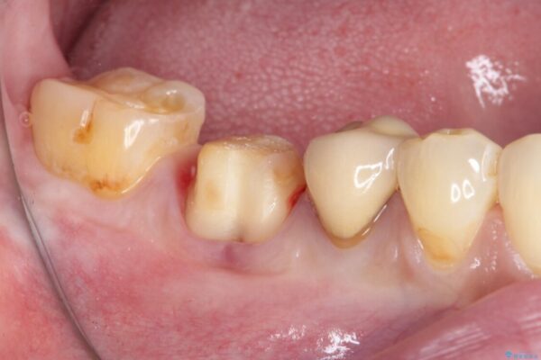奥歯が欠けてしまった　オールセラミッククラウンによる補綴治療 治療途中画像