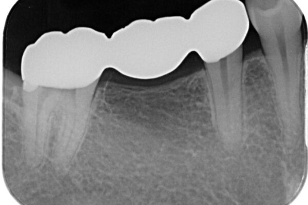 金属のブリッジをやり替えたい 治療後画像