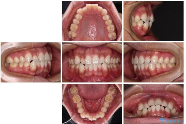 目立たない装置でデコボコを改善　ハーフリンガルによる矯正治療 治療前画像