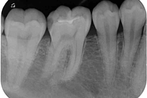 冷たいものがしみる　奥歯のセラミックインレー 治療前画像
