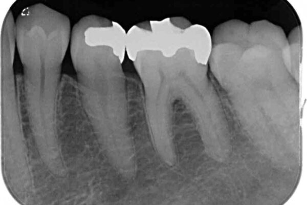 銀歯をセラミックにしたい　セラミックインレー修復 治療前画像