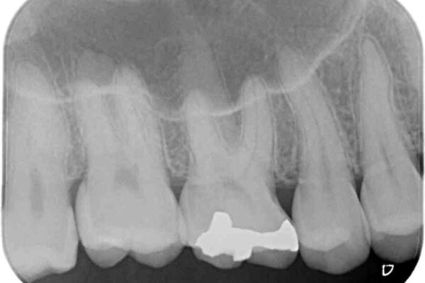 銀歯をセラミックにしたい　セラミックインレー修復 治療前画像