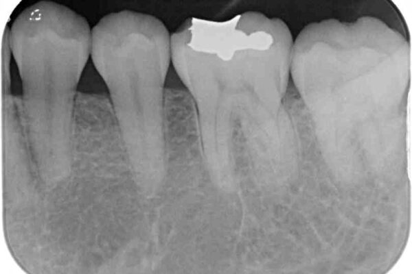 左下の奥歯が冷たいものがしみてザラザラする　ゴールドインレー修復 治療後画像