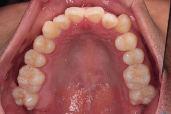 急速拡大装置　歯列弓を拡大して非抜歯ワイヤー矯正 治療前画像