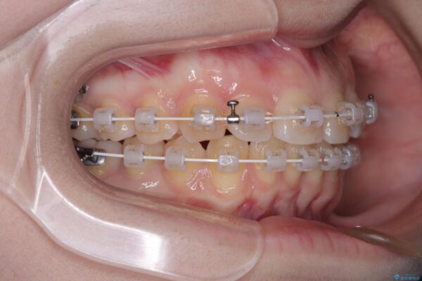 左上の前歯が出ているのが気になる　審美装置による非抜歯ワイヤー矯正 治療途中画像
