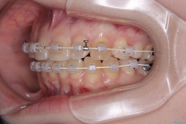 左上の前歯が出ているのが気になる　審美装置による非抜歯ワイヤー矯正 治療途中画像