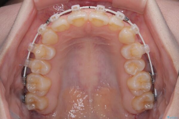 左上の前歯が出ているのが気になる　審美装置による非抜歯ワイヤー矯正 治療途中画像