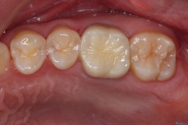 目立つ銀歯を白くしたい　セラミック治療 アフター