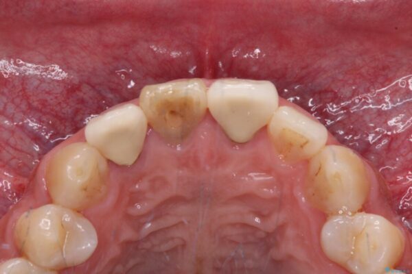 変色した前歯を治したい　オールセラミッククラウンによる補綴 治療前画像