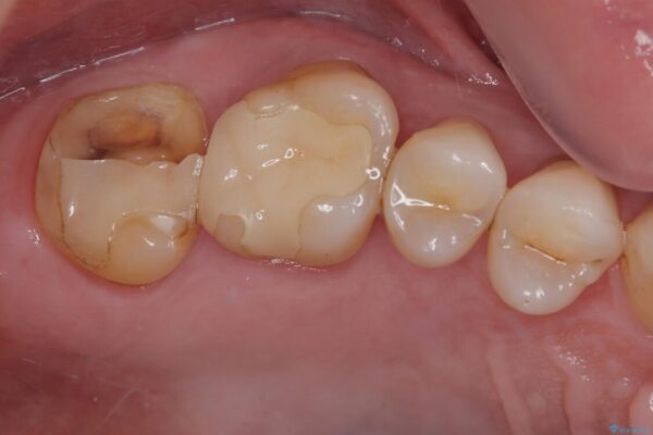 食事中に歯が欠けたので治したい。オールセラミッククラウンによる補綴 ビフォー