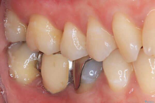 銀歯をやり替えたい。インプラントとセラミックによる治療 治療前画像