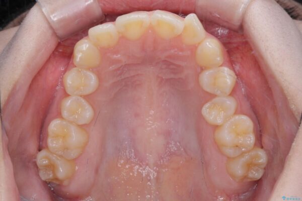 左上の前歯が出ているのが気になる　審美装置による非抜歯ワイヤー矯正 治療前画像