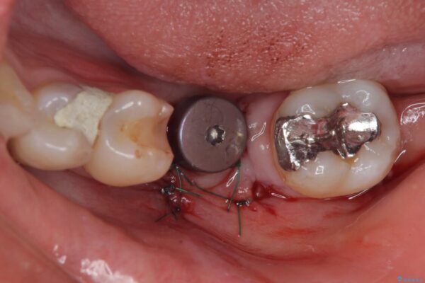 奥歯にインプラントを入れて銀歯もやり替えたい。 治療後画像