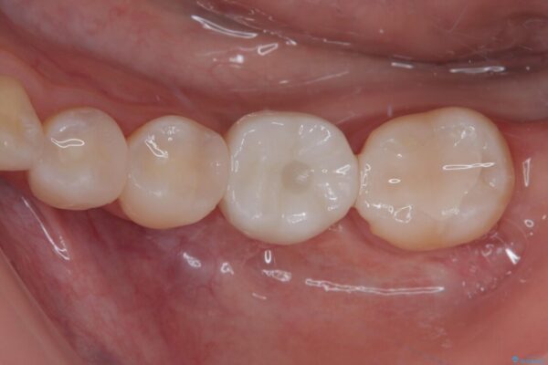 奥歯にインプラントを入れて銀歯もやり替えたい。 治療後画像