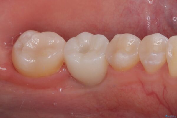 奥歯にインプラントを入れて銀歯もやり替えたい。 治療後画像