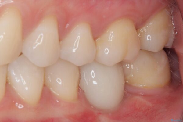 奥歯にインプラントを入れて銀歯もやり替えたい。 治療後画像