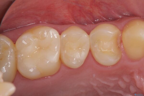 詰め物が外れた　セラミックインレー修復 治療前画像