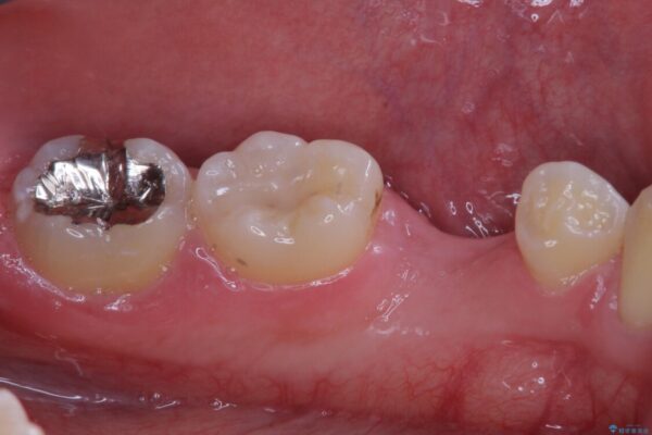 永久歯の先天欠如　インプラントによる補綴 治療前画像