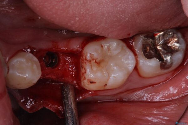 永久歯の先天欠如　インプラントによる補綴 治療前画像
