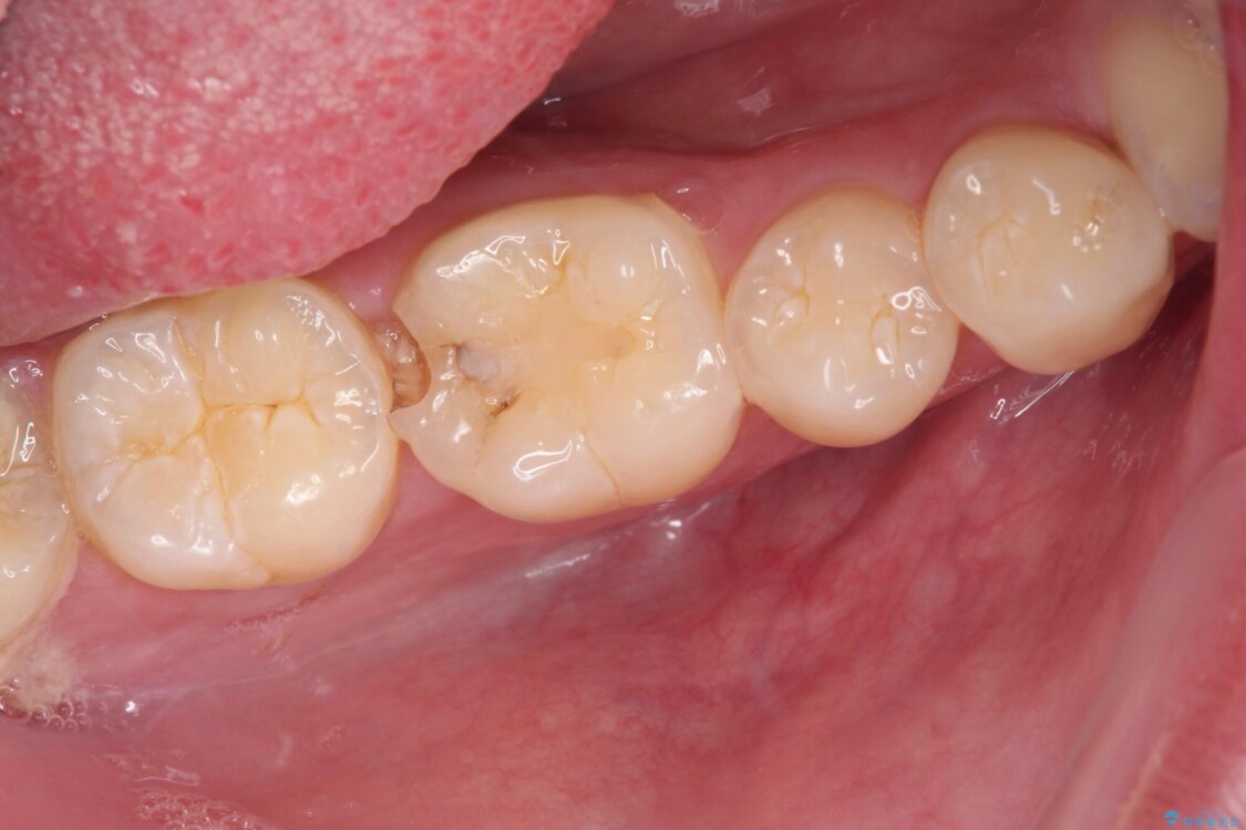 冷たいものがしみる　奥歯のセラミックインレー 治療前