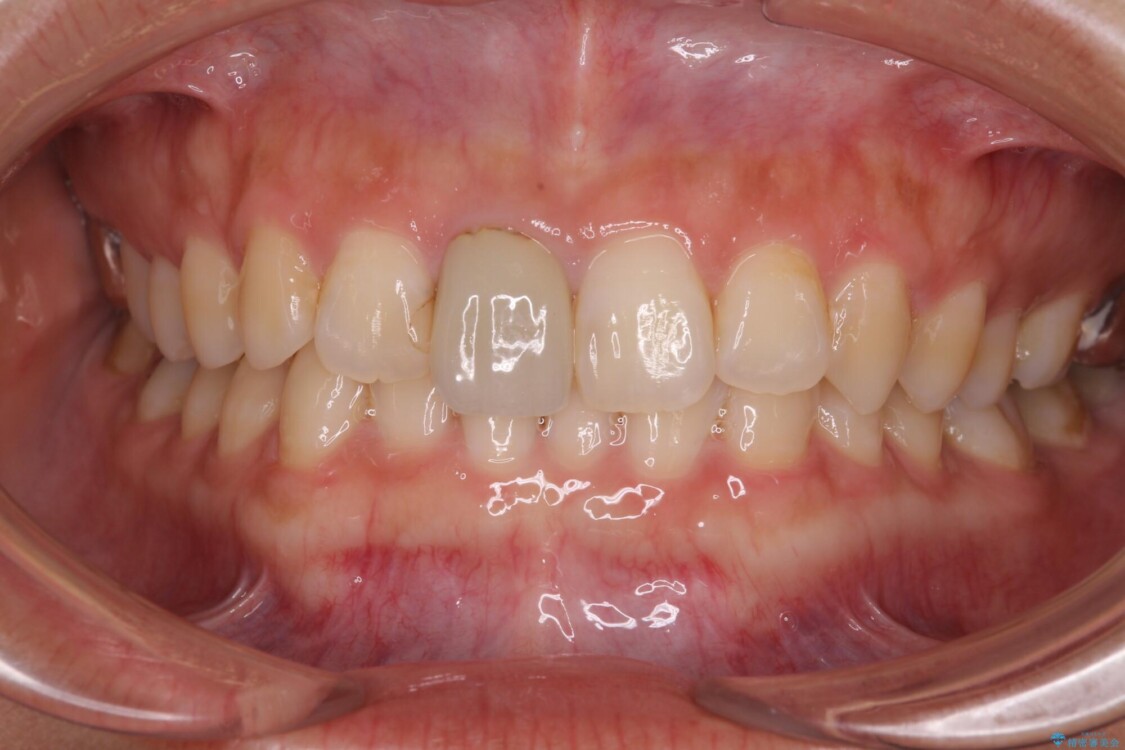 不自然な前歯の被せものをやり替えたい 治療前