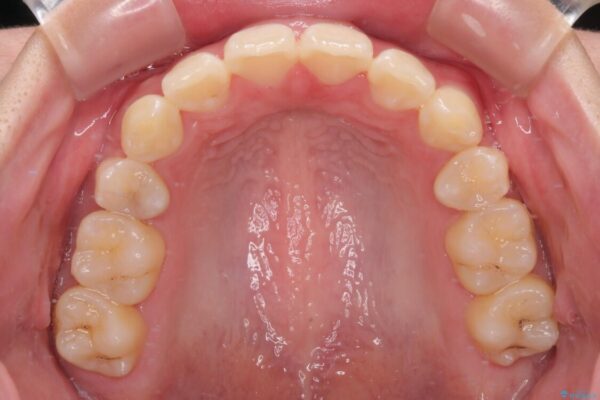 口元が出ているのを改善したい。　クリアブラケットによる抜歯矯正 治療後画像