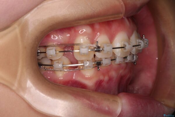 口元が出ているのを改善したい。　クリアブラケットによる抜歯矯正 治療途中画像