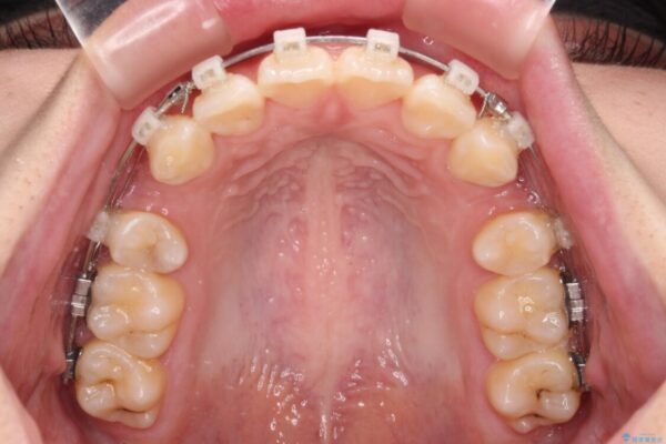 口元が出ているのを改善したい。　クリアブラケットによる抜歯矯正 治療途中画像