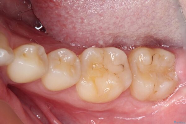 左下の奥歯が冷たいものがしみてザラザラする　ゴールドインレー修復 ビフォー