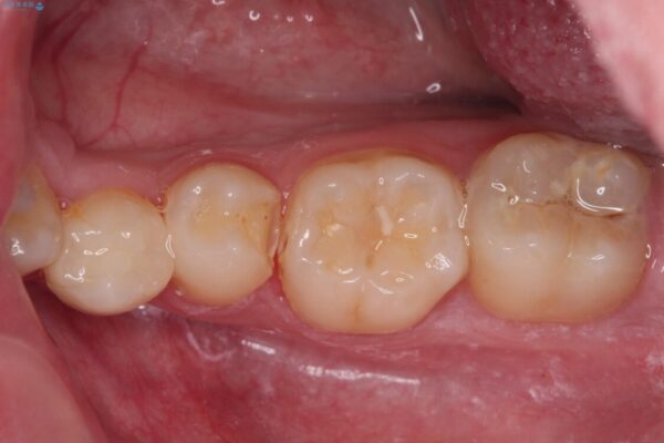詰め物が欠けた　セラミックインレーによる修復 ビフォー