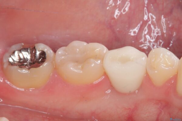 永久歯の先天欠如　インプラントによる補綴 治療後画像