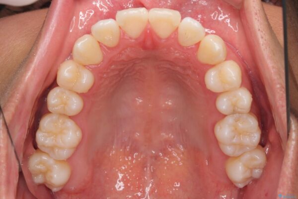 急速拡大装置　歯列弓を拡大して非抜歯ワイヤー矯正 治療後画像
