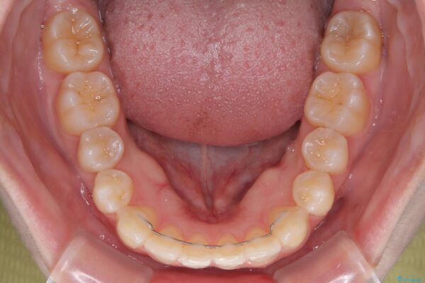 左上の前歯が出ているのが気になる　審美装置による非抜歯ワイヤー矯正 治療後画像