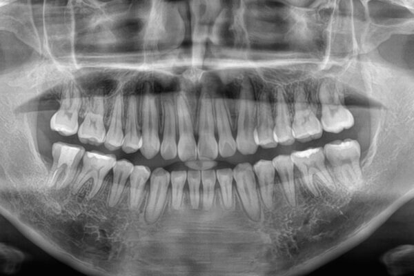 目立たない装置でデコボコを改善　ハーフリンガルによる矯正治療 治療後画像