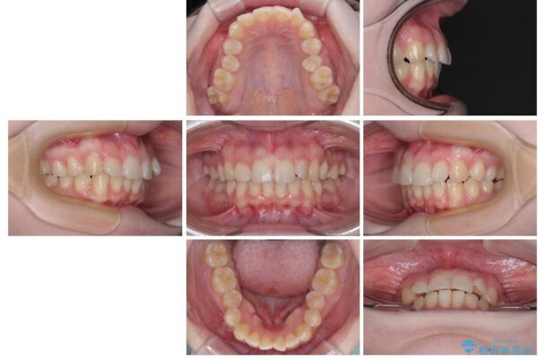 左上の前歯が出ているのが気になる　審美装置による非抜歯ワイヤー矯正 治療前画像