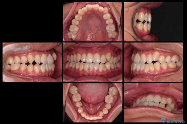 急速拡大装置　歯列弓を拡大して非抜歯ワイヤー矯正 治療前画像