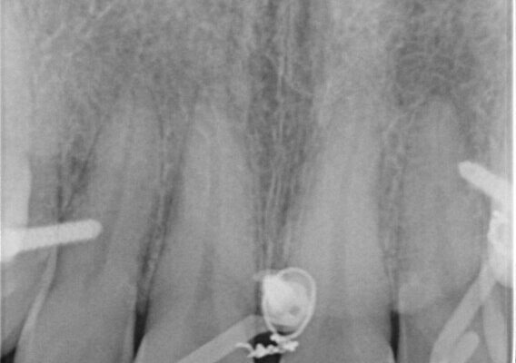 転んで欠けた前歯を治したい。オールセラミッククラウンによる補綴 治療前画像