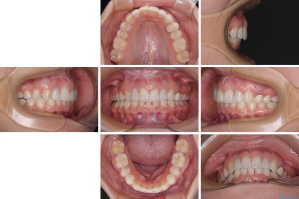 【モニター】前歯の変色とデコボコを改善　インビザラインとオールセラミック 治療後画像