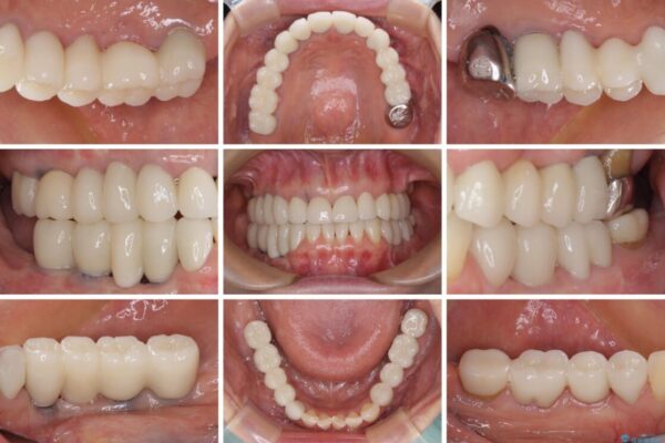 以前治療した歯がボロボロに　全顎補綴治療 治療後画像