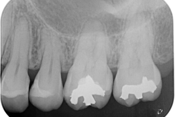 歯に穴があいてフロスが引っかかる　セラミックインレー修復 治療後画像