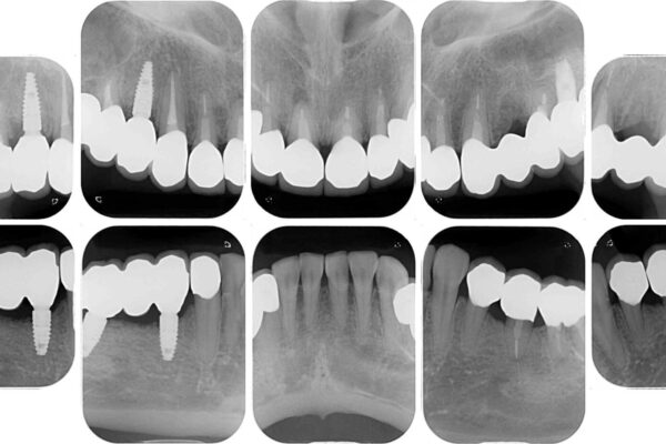 以前治療した歯がボロボロに　全顎補綴治療 治療後画像