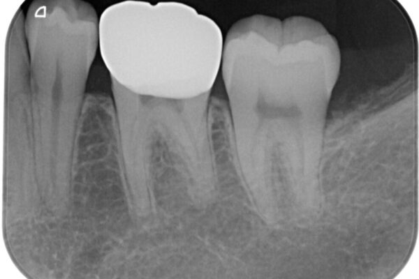 銀歯のところがしみる　オールセラミッククラウン 治療後画像