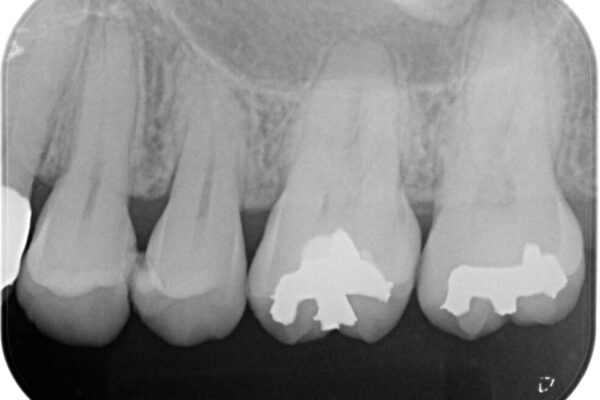 歯に穴があいてフロスが引っかかる　セラミックインレー修復 治療前画像