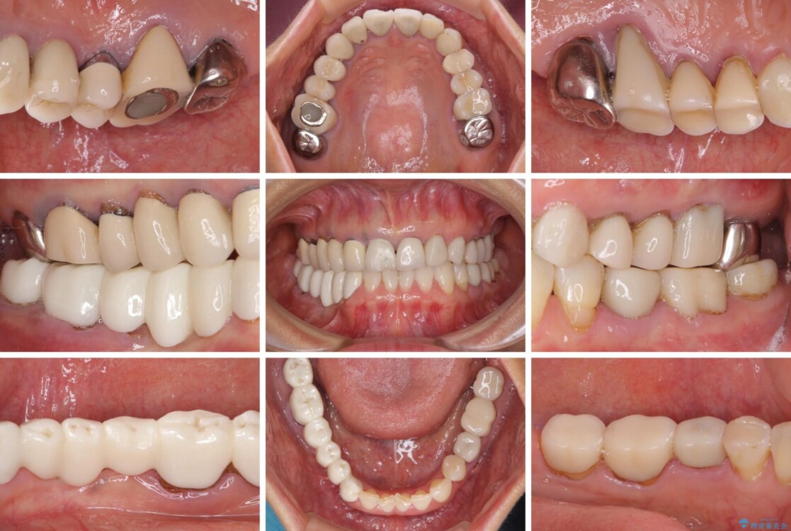 以前治療した歯がボロボロに　全顎補綴治療 治療前