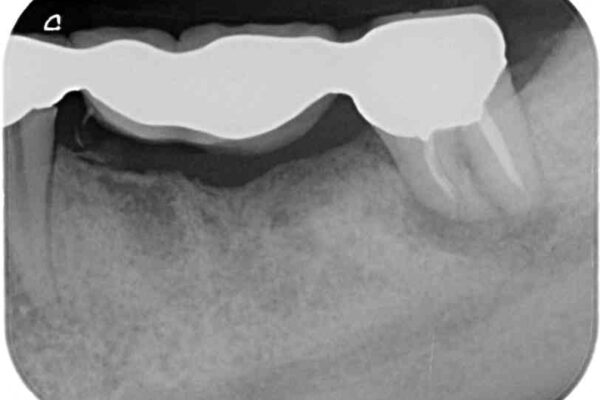 インプラントや歯周外科処置を用いた奥歯の補綴治療 ビフォー